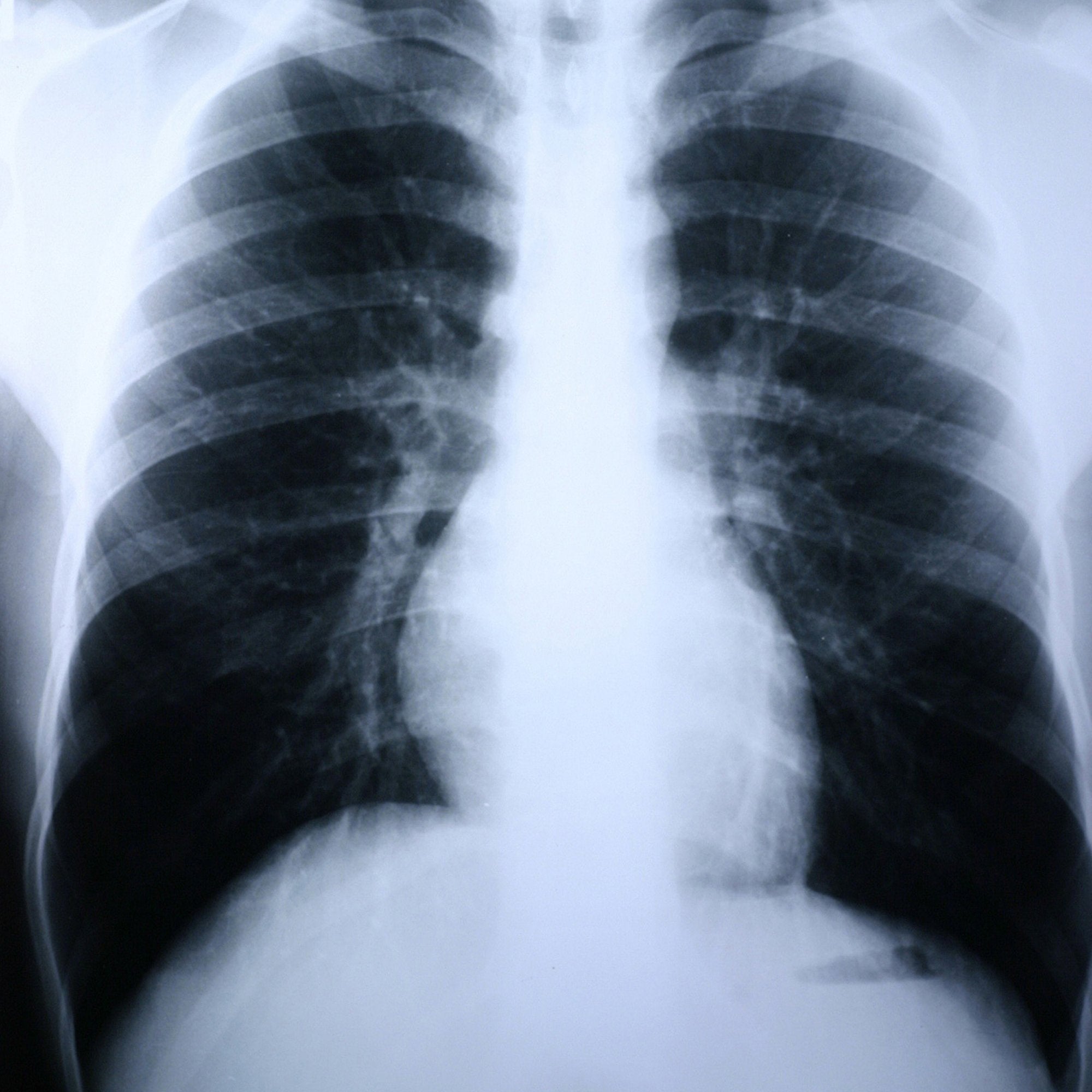 Clear Choice Performance X-Ray Film-X-Ray Film Clear Choice Performance 8 X 10 Inch Medium Speed Green Sensitive High