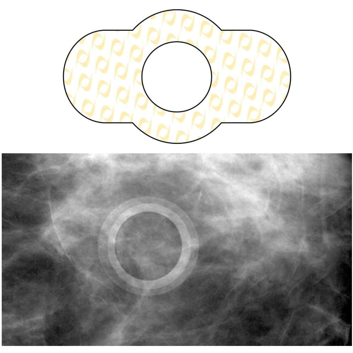 Spee-D-Ring Skin Marker-Radiology Skin Marker Spee-D-Ring