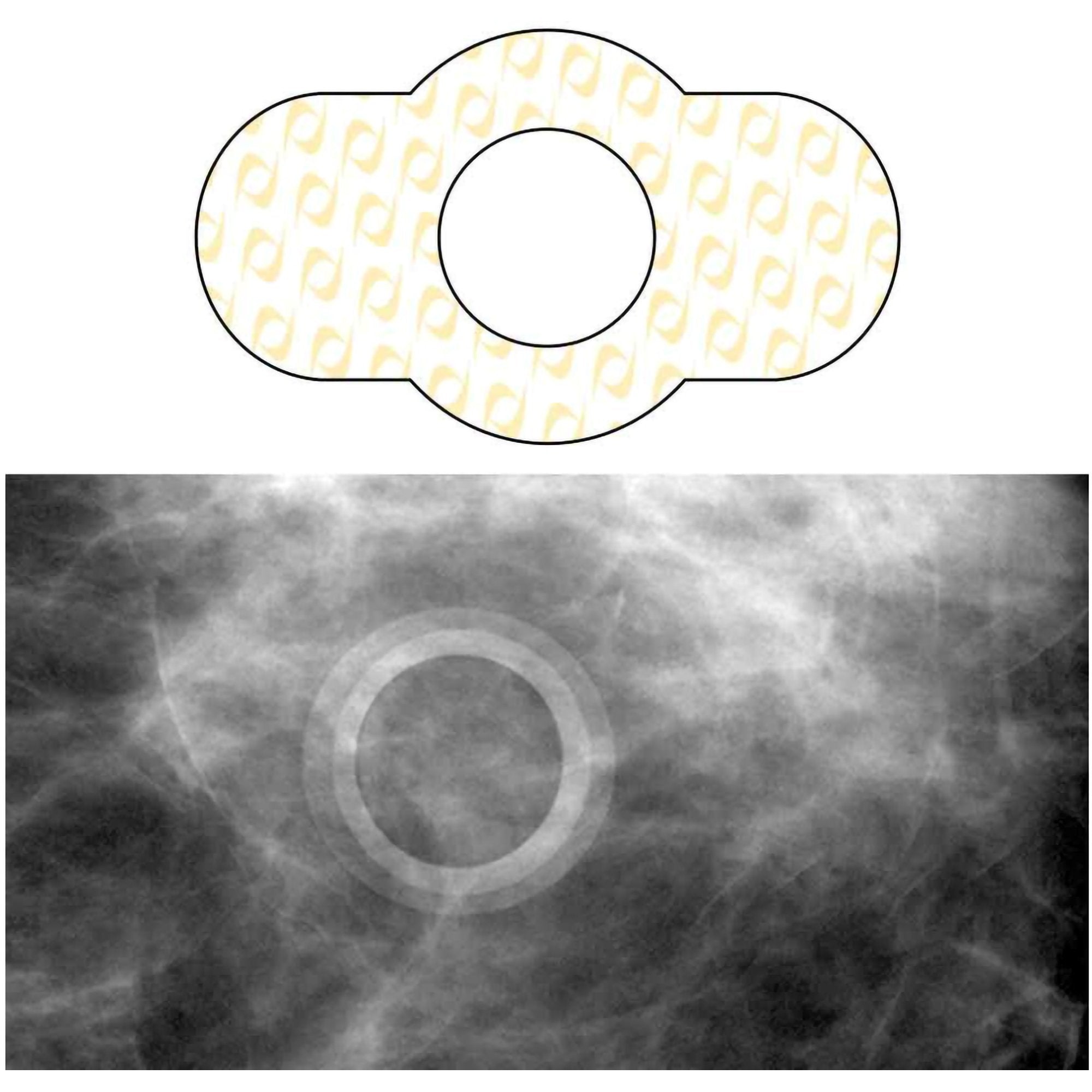 Spee-D-Ring Skin Marker-Radiology Skin Marker Spee-D-Ring