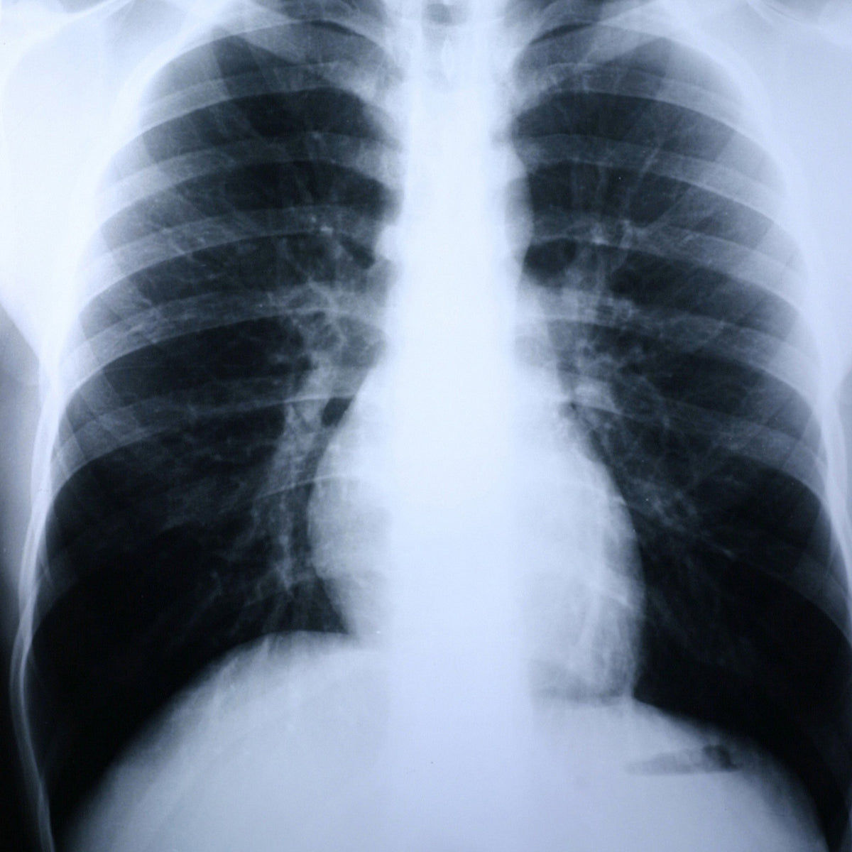 Clear Choice Performance X-Ray Film-X-Ray Film Clear Choice Performance 14 X 17 Inch Medium Speed Green Sensitive High