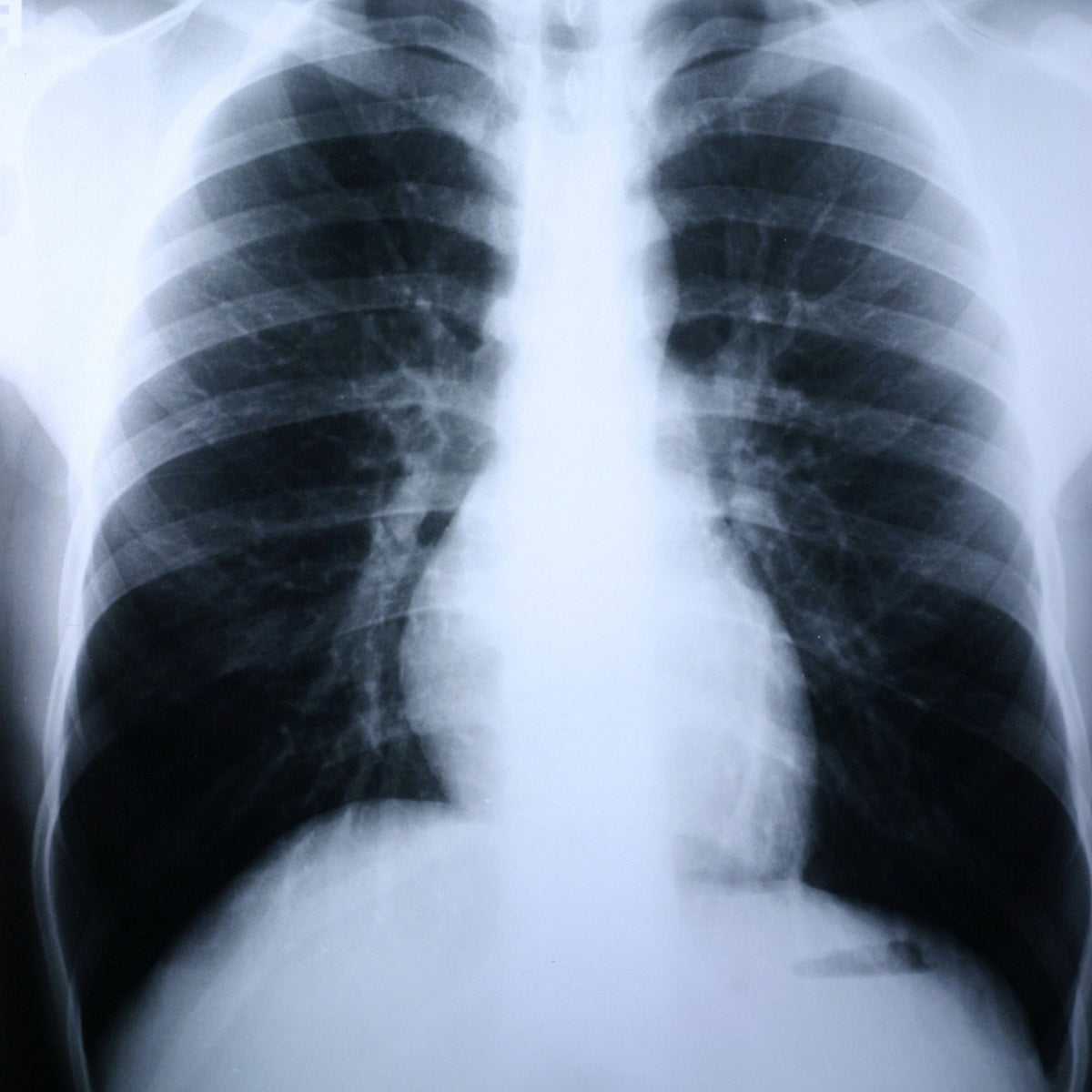 Clear Choice Performance X-Ray Film-X-Ray Film Clear Choice Performance 10 X 12 Inch Medium Speed Green Sensitive High