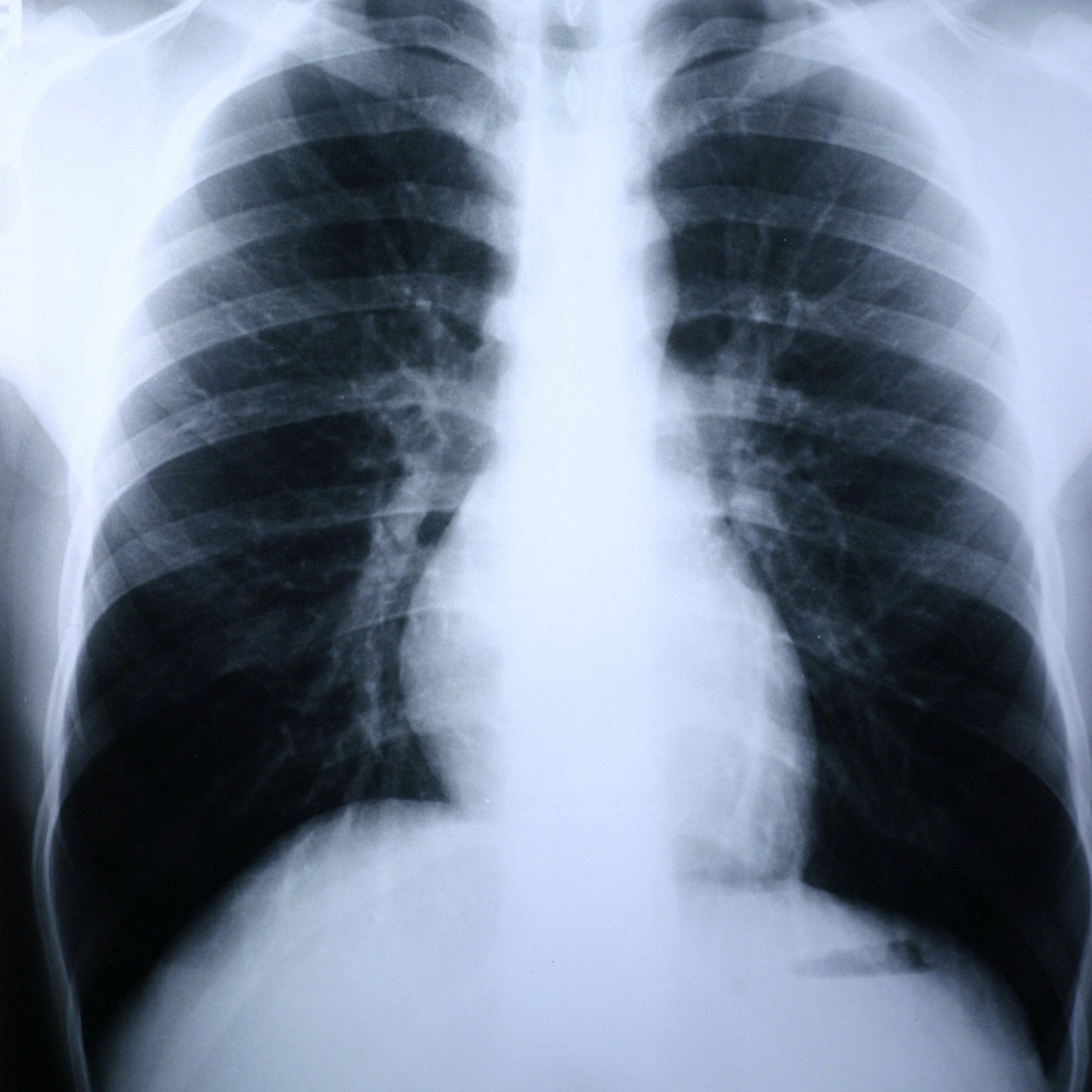Clear Choice Performance X-Ray Film-X-Ray Film Clear Choice Performance 10 X 12 Inch Medium Speed Green Sensitive High